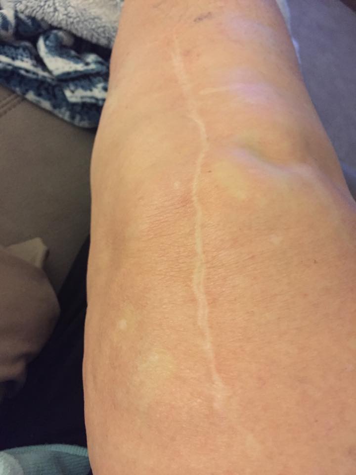 How Long Does It Take For A Knee Replacement Scar To Fade